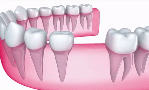 Macro Dental Implant Excellence