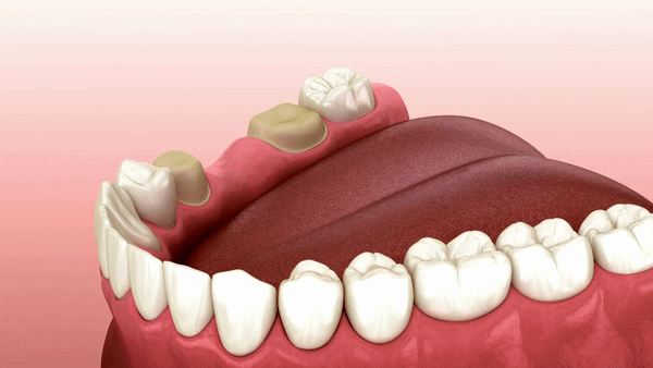 Dental Bridges animation