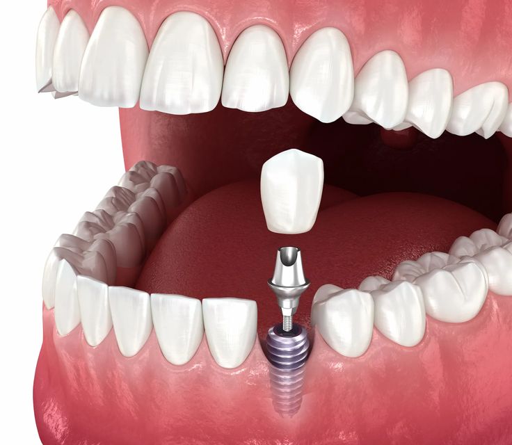 Clear Aligners