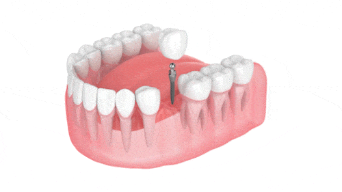 Dental Implants animation