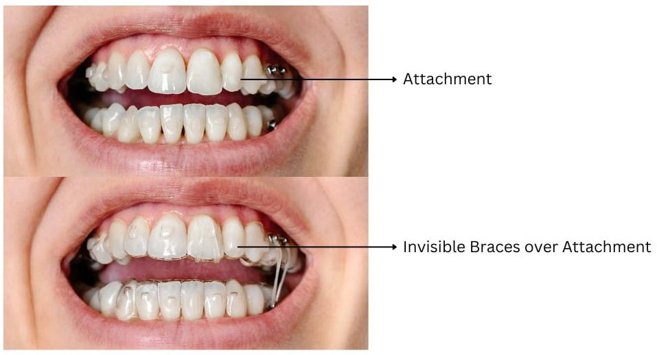 Clear Aligner Macro