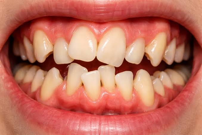 Teen Aligner Solutions
