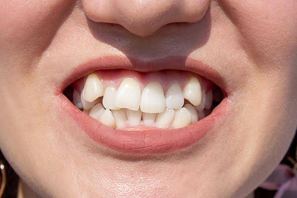 Invisalign Treatment