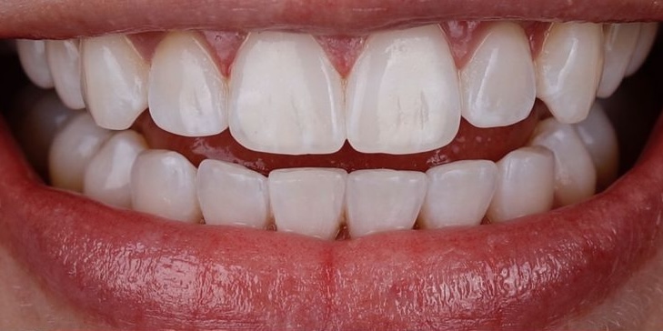After Treatment