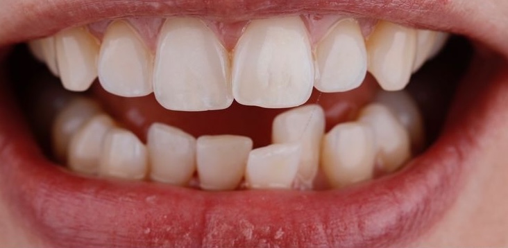 Before Treatment