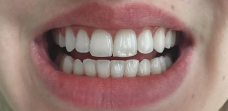 After Treatment