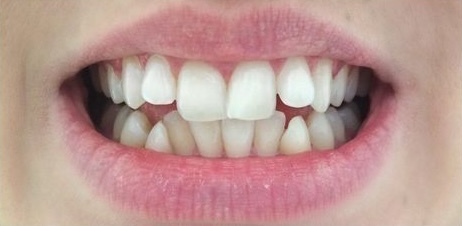 Before Treatment
