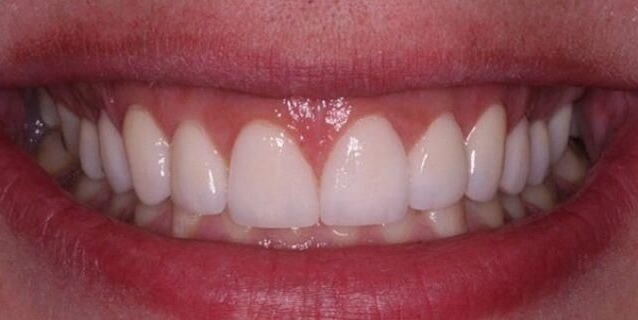 After Treatment