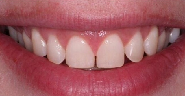 Before Treatment