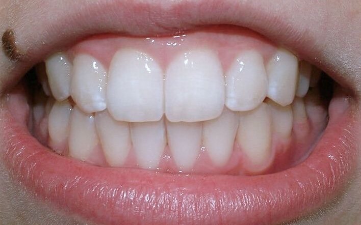 After Treatment