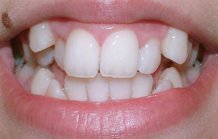 Before Treatment
