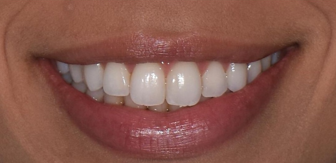 After Treatment