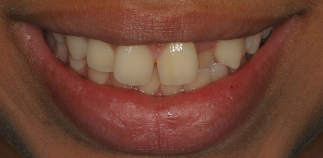 Before Treatment