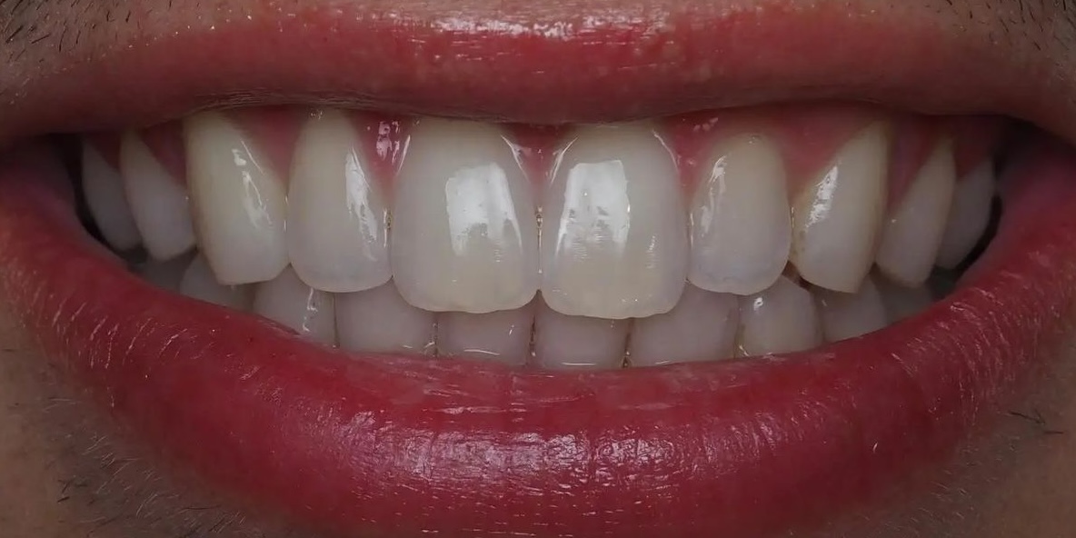After Treatment