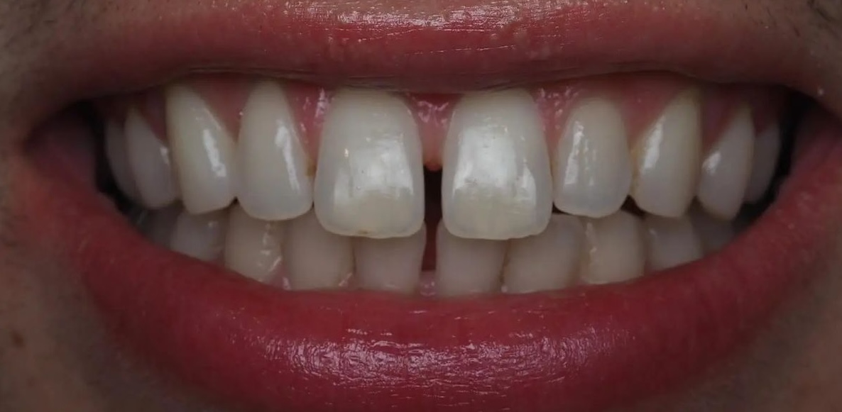 Before Treatment