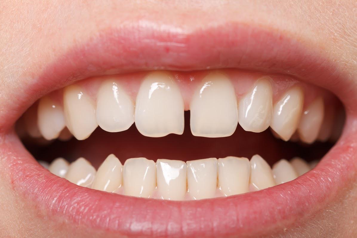 Aurra Clear Aligners