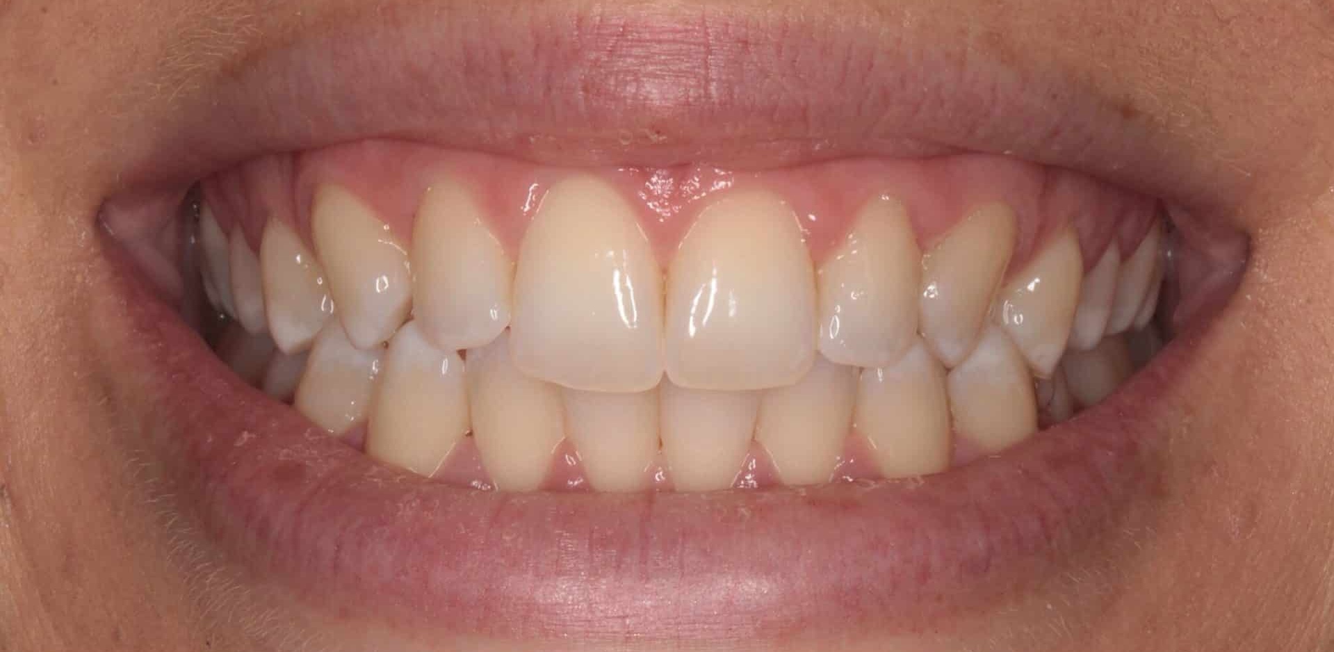 After Whitening