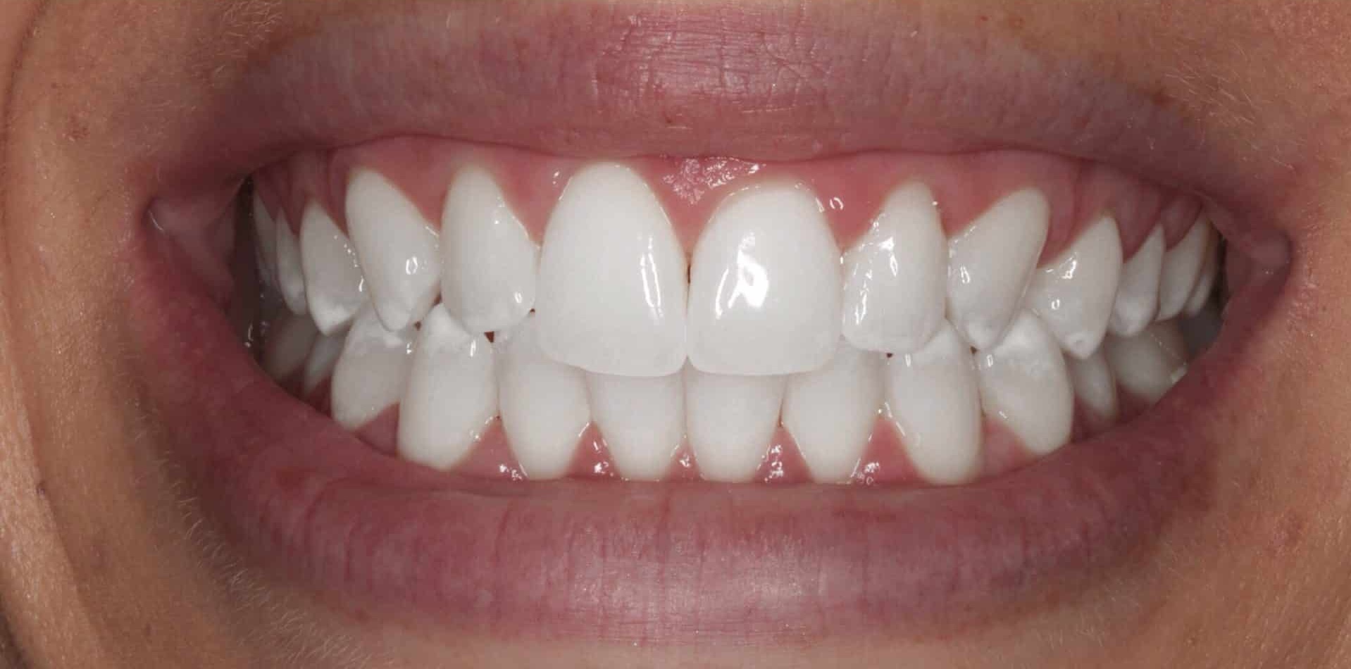 Before Whitening