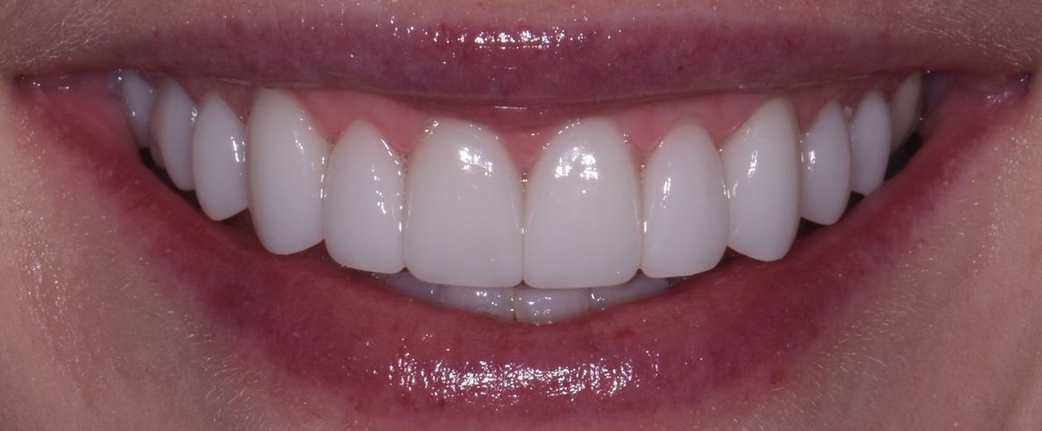 Before Refinement