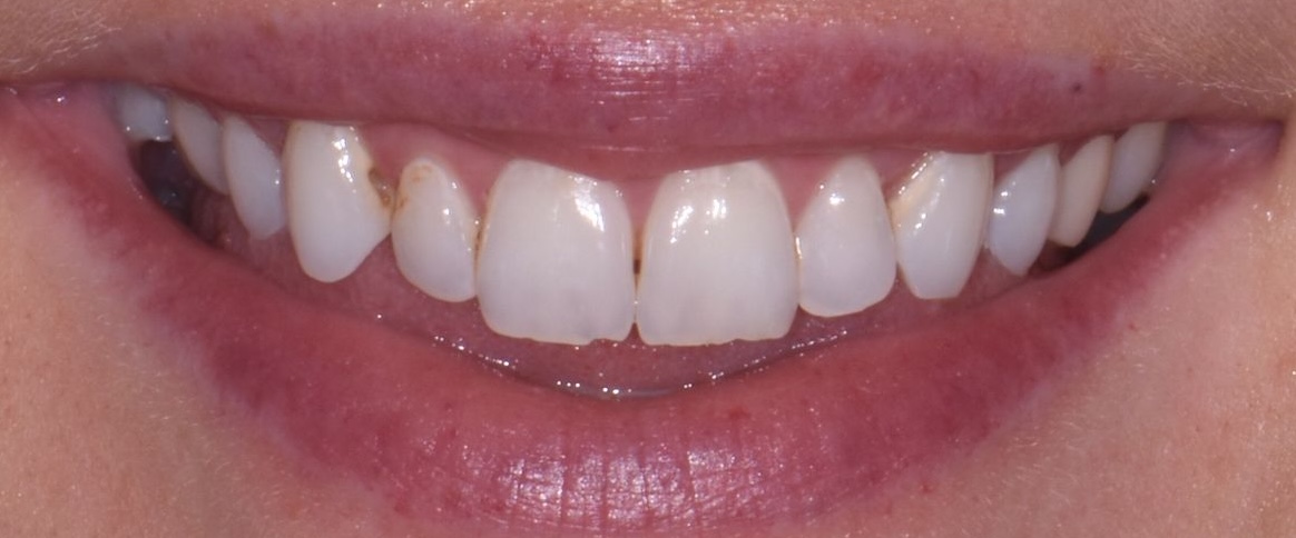 After Refinement